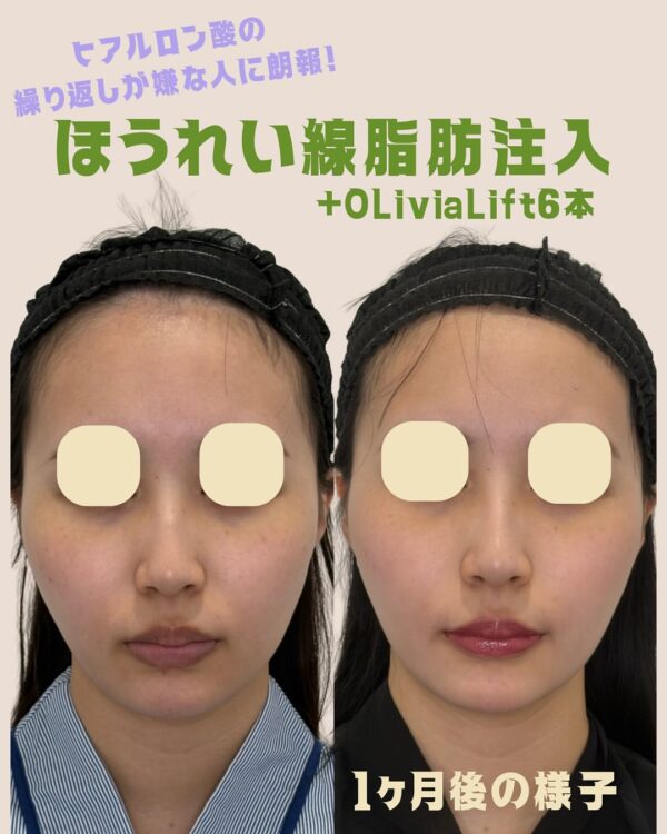 231 ほうれい線脂肪注入 × Olivia lift × ヒアルロン酸注入