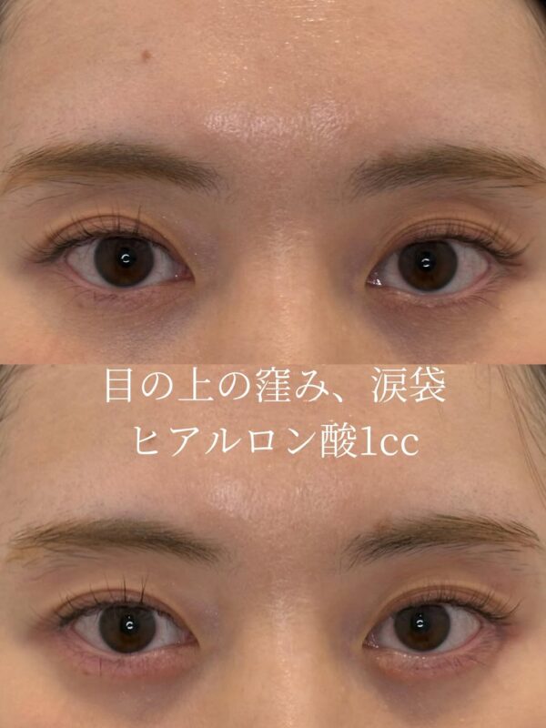 232 目の上の窪みヒアルロン酸注入