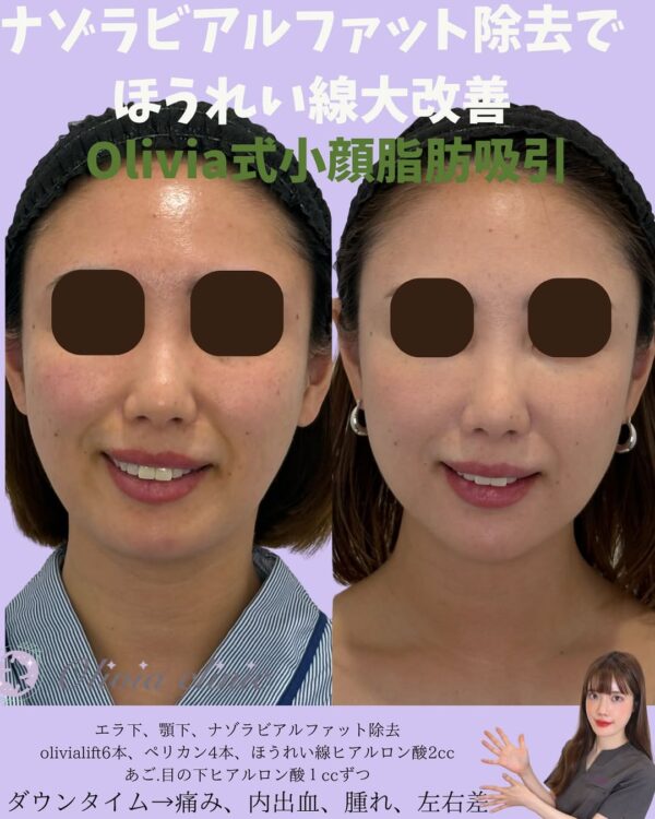 233 Olivia式小顔脂肪吸引 × ナゾラビアルファット除去 × Olivia lift × ペリカンリフト × ヒアルロン酸