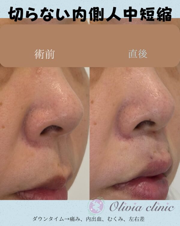234 切らない内側人中短縮