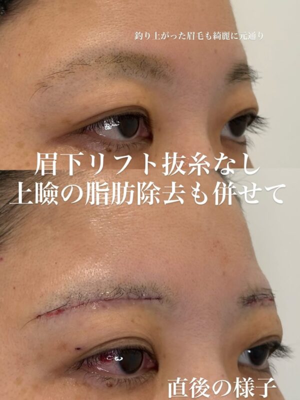 235 眉下リフト抜糸なし × 上瞼の脂肪除去