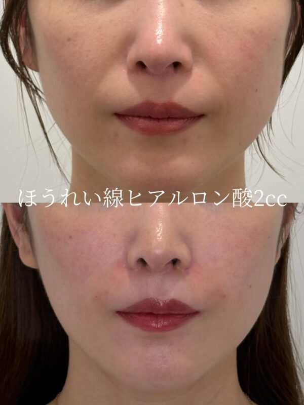 237 ほうれい線ヒアルロン酸