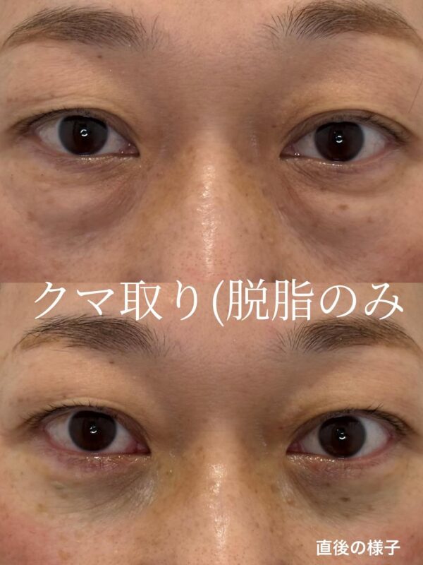 238 クマ取り(脱脂) × コンデンスリッチ脂肪注入