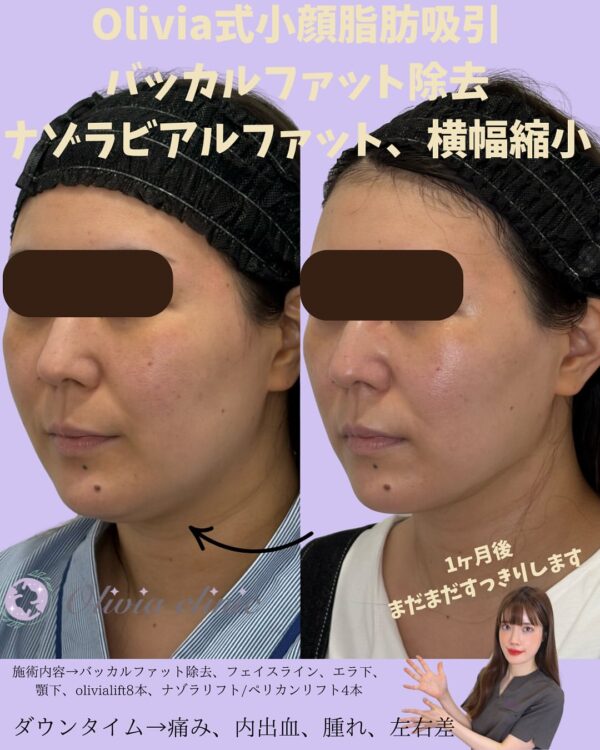 239 Olivia式小顔脂肪吸引 × ナゾラビアルファット除去 × Olivia lift × ペリカンリフト × 横幅縮小