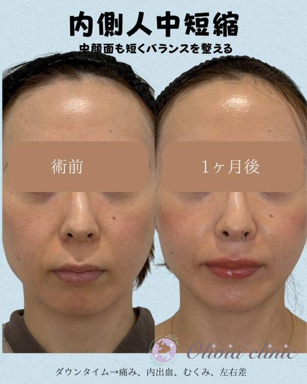 240 内側人中短縮