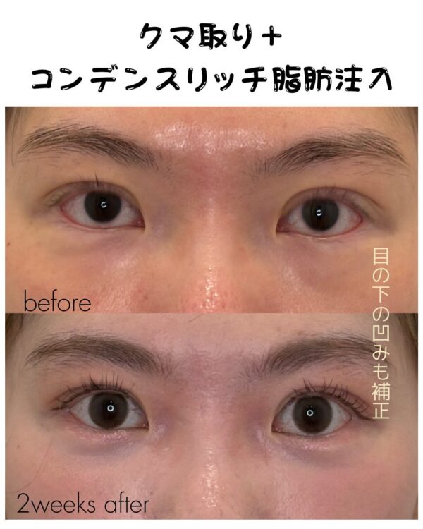 241 クマ取り(脱脂) × コンデンスリッチ脂肪注入