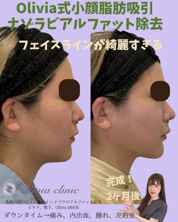 242 Olivia式小顔脂肪吸引 × ナゾラビアルファット除去 × Olivia lift