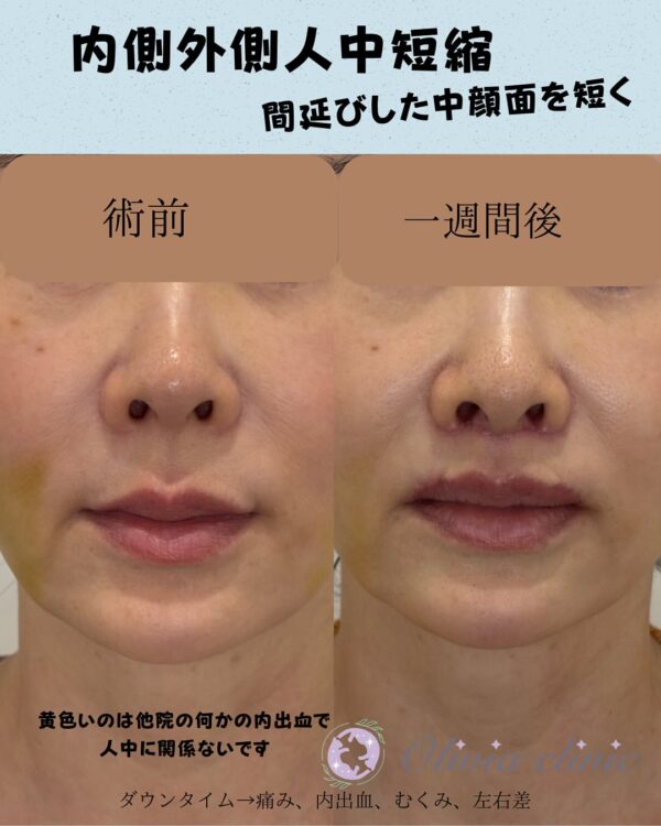 243 内側外側人中短縮