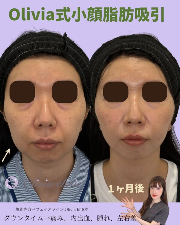 244 Olivia式小顔脂肪吸引 ×Olivia lift