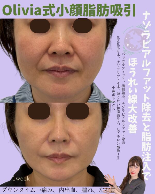 246 Olivia式小顔脂肪吸引 × × ナゾラビアルファット除去 × バッカルファット除去  × Olivia lift × ナゾラリフト × 横幅縮小 × ほうれい線脂肪注入 × ヒアルロン酸 × ボツリヌストキシン