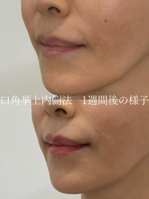 247 口角拳上内側法