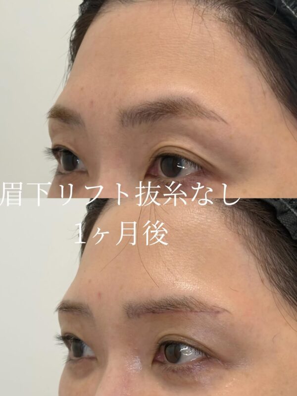 251 眉下リフト抜糸なし