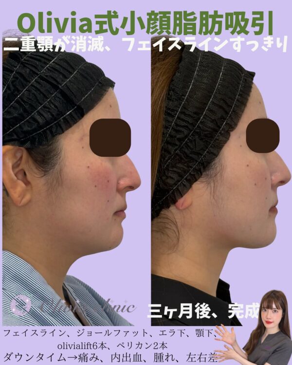 252 Olivia式小顔脂肪吸引 × ジョールファット除去 × Olivia lift × ペリカンリフト
