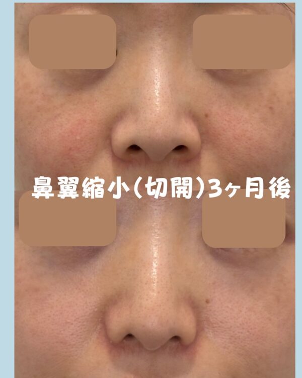 254 鼻翼縮小(切開)