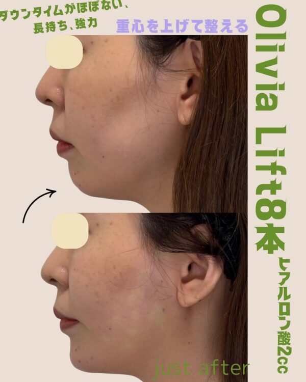 255 Olivia lift × ヒアルロン酸