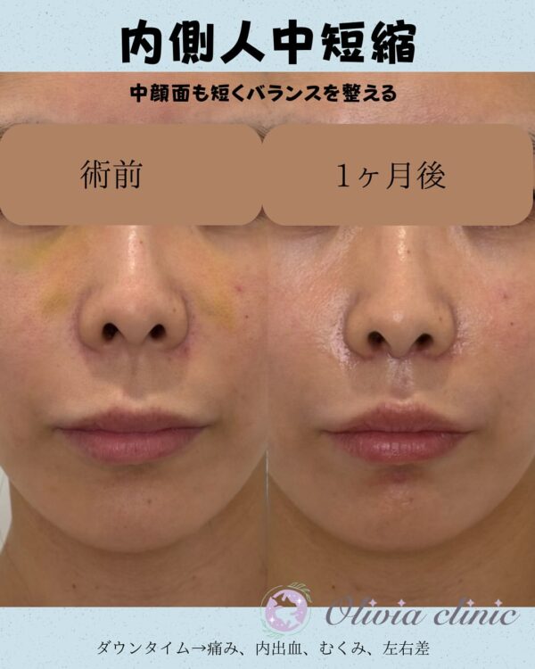 256 内側人中短縮