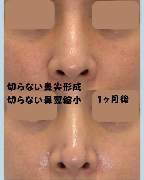 257 切らない鼻尖形成・切らない鼻翼縮小 × ヒアルロン酸