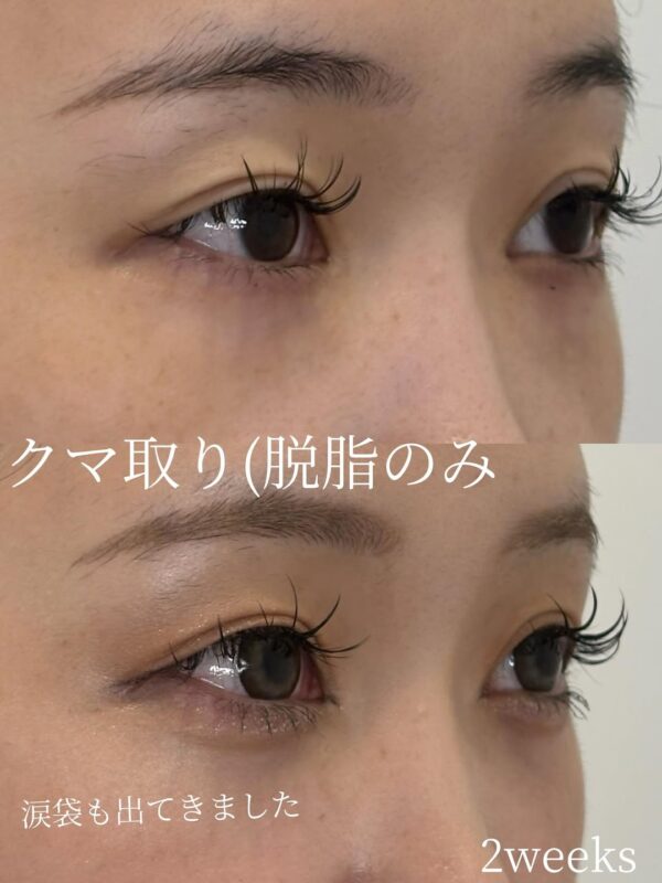 259 クマ取り(脱脂) × コンデンスリッチ脂肪注入