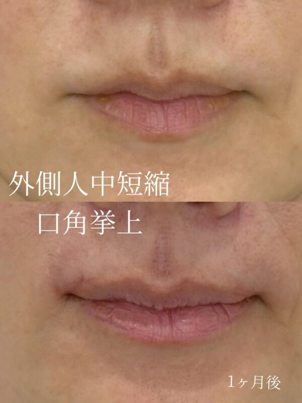 260 外側人中短縮 × 口角拳上 × ボツリヌストキシン注射(顔)