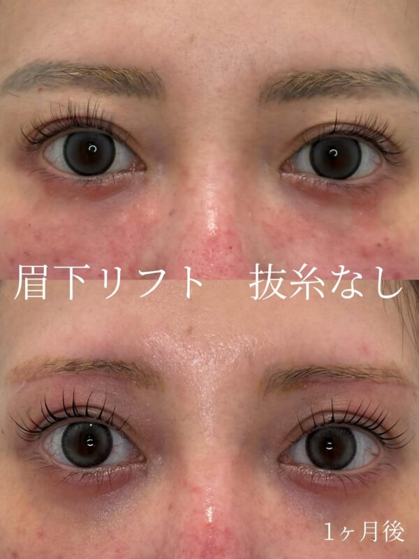 262 眉下リフト抜糸なし