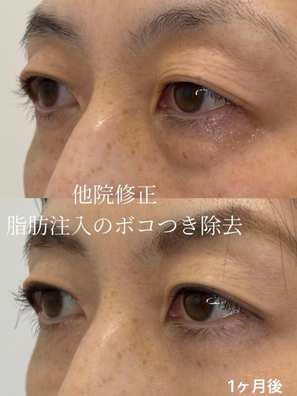 263 他院脱脂と脂肪注入のクマ取り修正