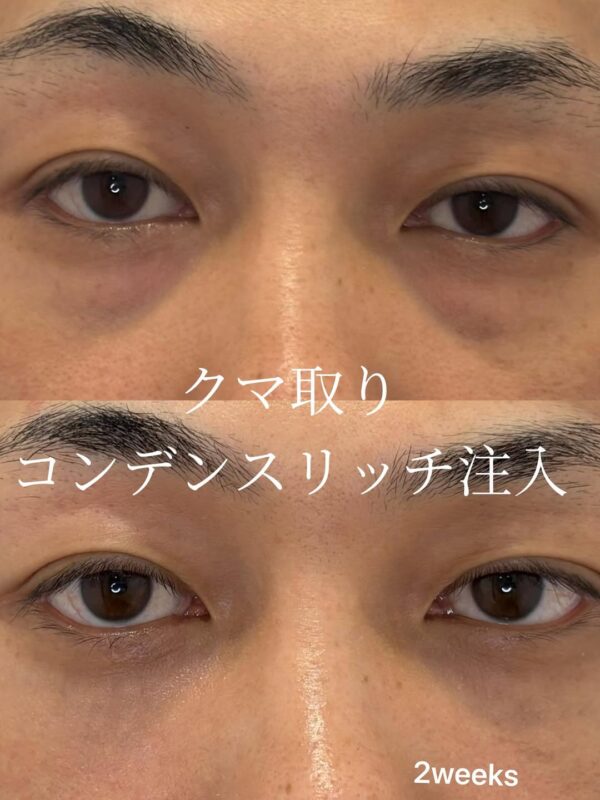 264 クマ取り(脱脂) × コンデンスリッチ脂肪注入