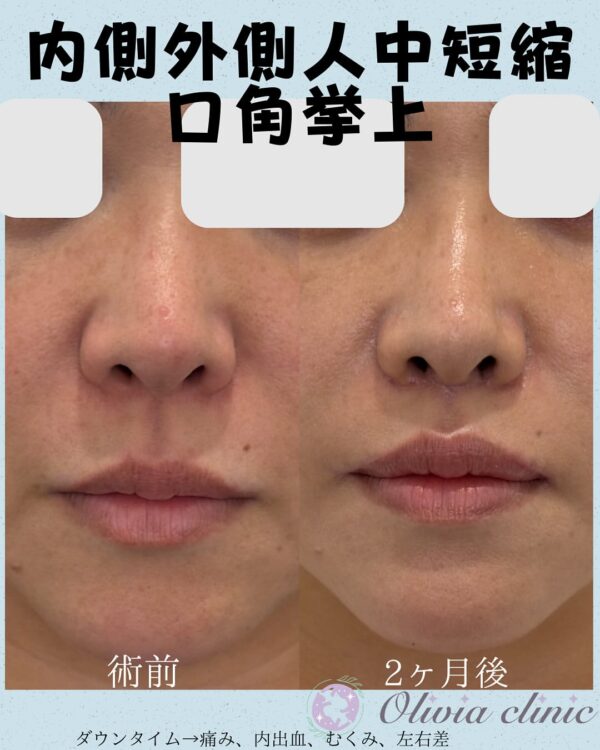 265 外側人中短縮 × 口角拳上