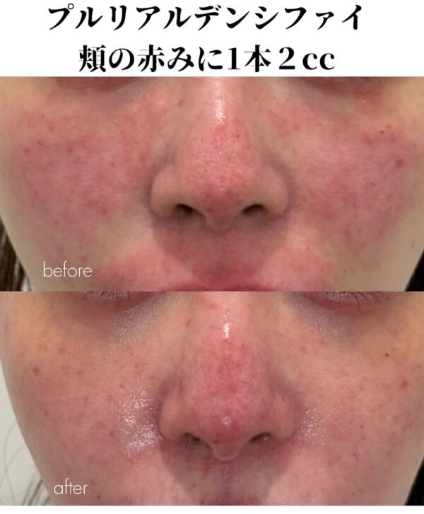 261 プルリアルデンシファイ