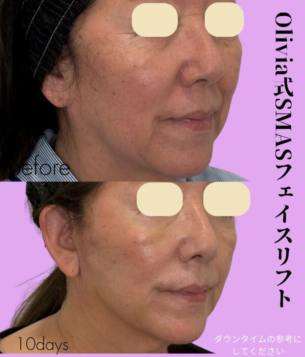 268 Olivia式SMASフェイスリフト × Olivia式小顔脂肪吸引 × Olivia lift