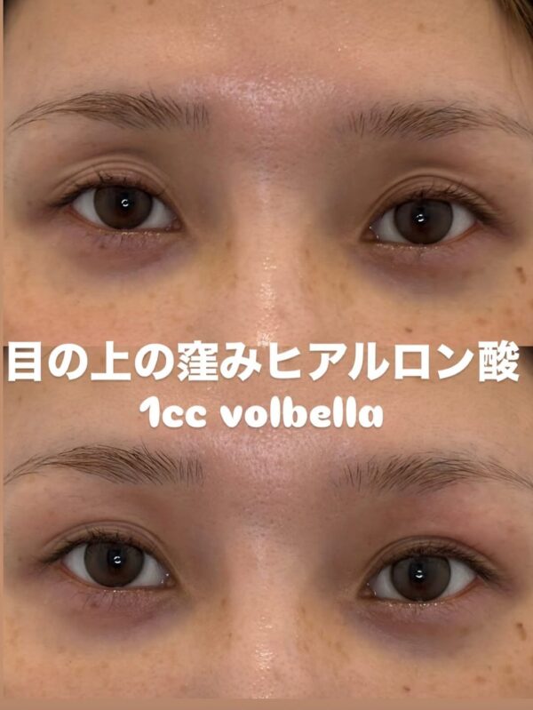 269 ヒアルロン酸注入