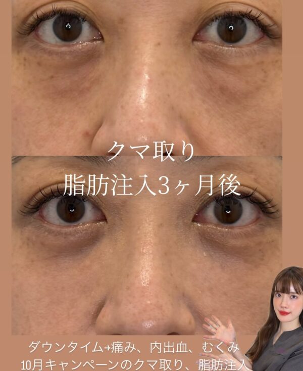 270 クマ取り(脱脂) × 脂肪注入