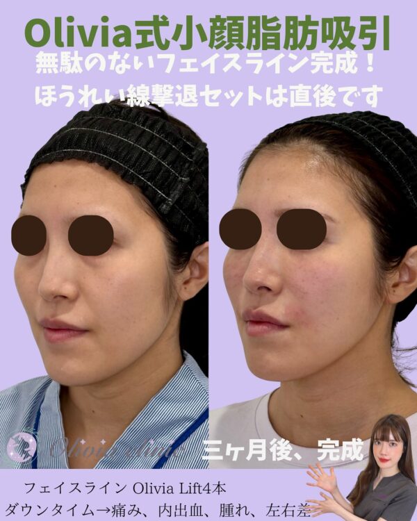 271 Olivia式小顔脂肪吸引 × Olivia lift