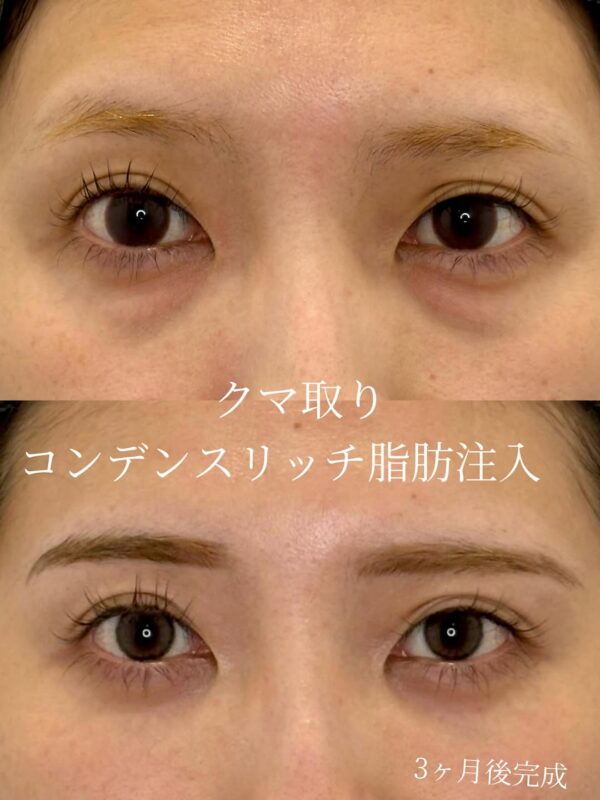 273 クマ取り(脱脂) × コンデンスリッチ脂肪注入