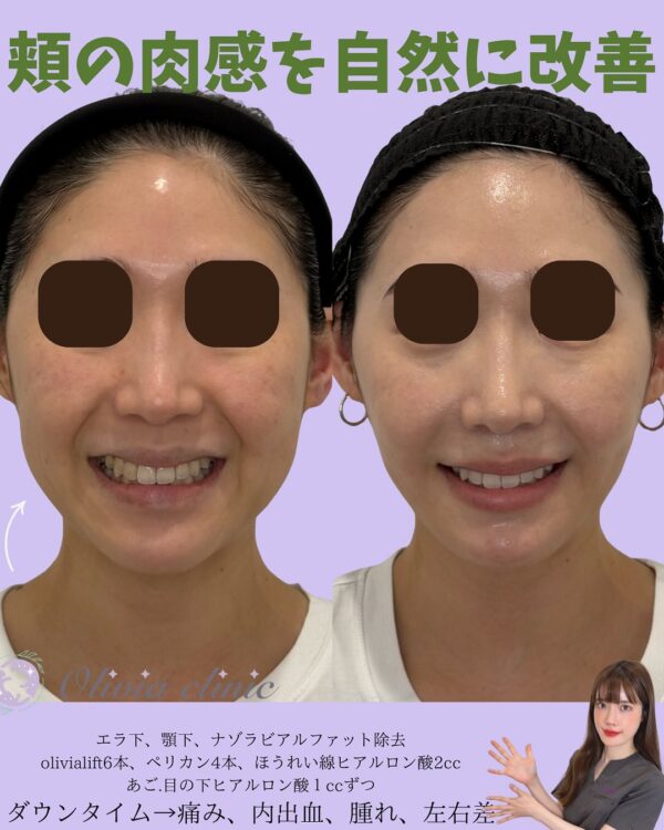274 Olivia式小顔脂肪吸引 × ナゾラビアルファット除去 × バッカルファット除去  × ジョールファット除去 × Olivia lift × ペリカンリフト × ショッピングリフト × ナゾラリフト × ヒアルロン酸 × PRP注入
