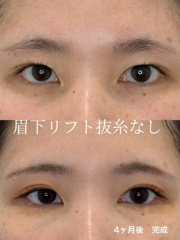 275 眉下リフト抜糸なし