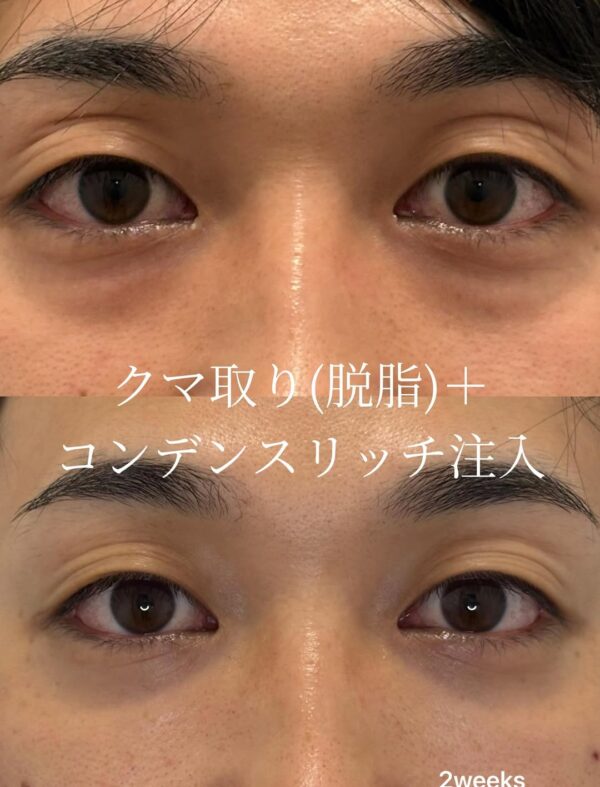 276 クマ取り(脱脂) × コンデンスリッチ脂肪注入