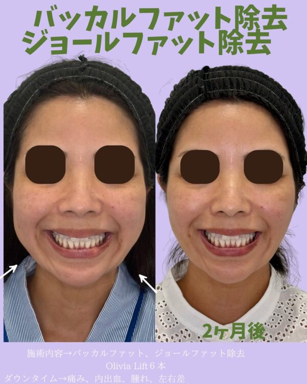 277 Olivia式小顔脂肪吸引 × バッカルファット除去 × ジョールファット除去 × Olivia lift