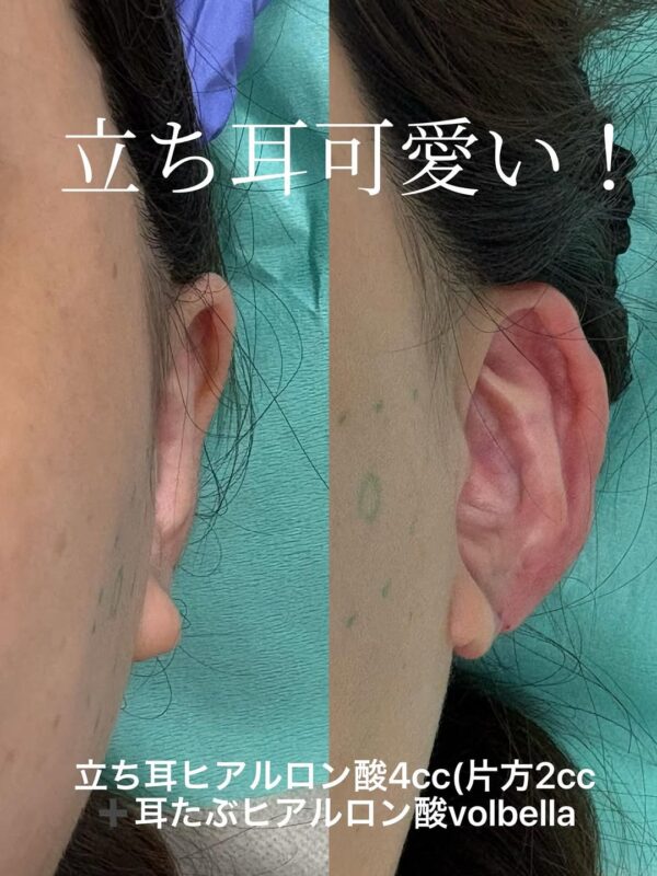 279 立ち耳ヒアルロン酸 × 耳たぶヒアルロン酸