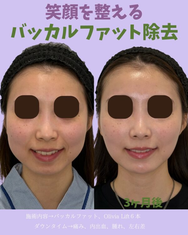 278 Olivia式小顔脂肪吸引 × バッカルファット除去 × Olivia lift