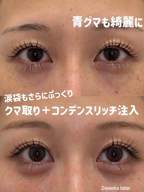 281 クマ取り(脱脂) × コンデンスリッチ脂肪注入