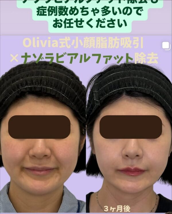 282 Olivia式小顔脂肪吸引 × ナゾラビアルファット除去