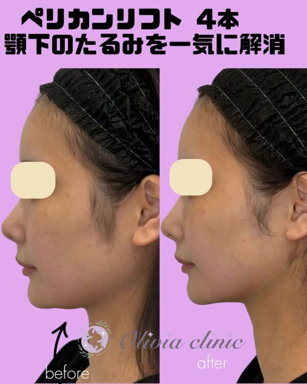 283 ペリカンリフト