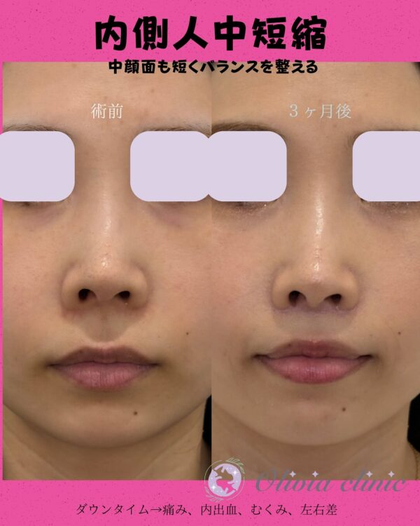 284 内側人中短縮