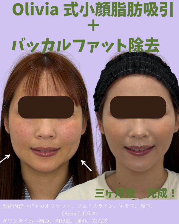 286 Olivia式小顔脂肪吸引 × バッカルファット除去 × Olivia lift