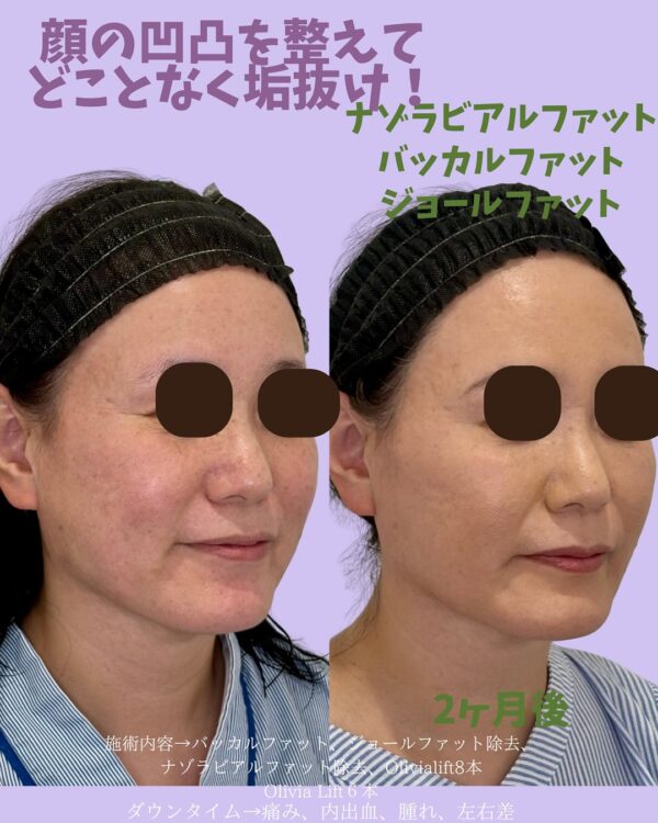 285 Olivia式小顔脂肪吸引 × ナゾラビアルファベット除去 × バッカルファット除去 × ジョールファット除去 × Olivia lift