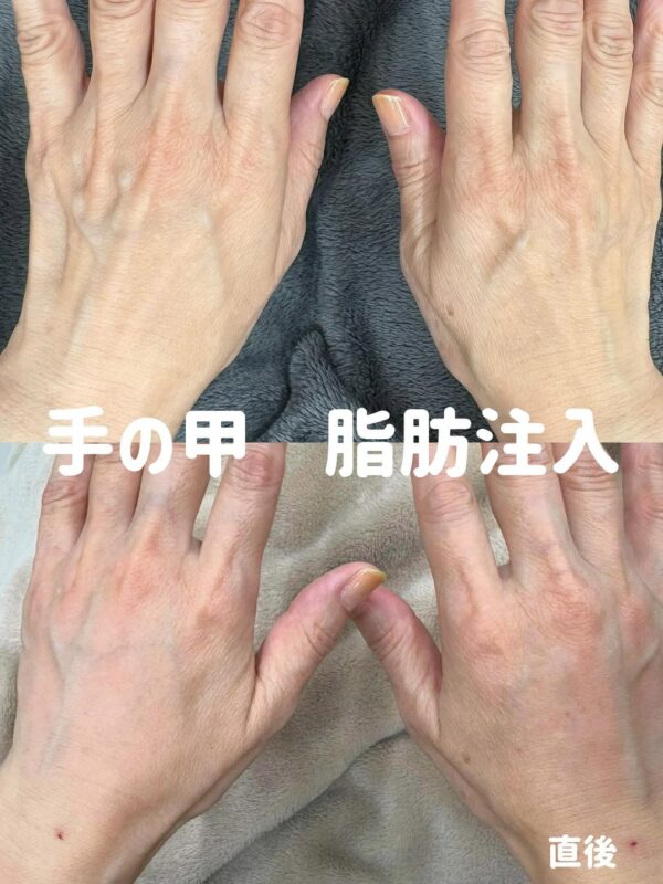 287 手の甲 脂肪注入 × PRP注入