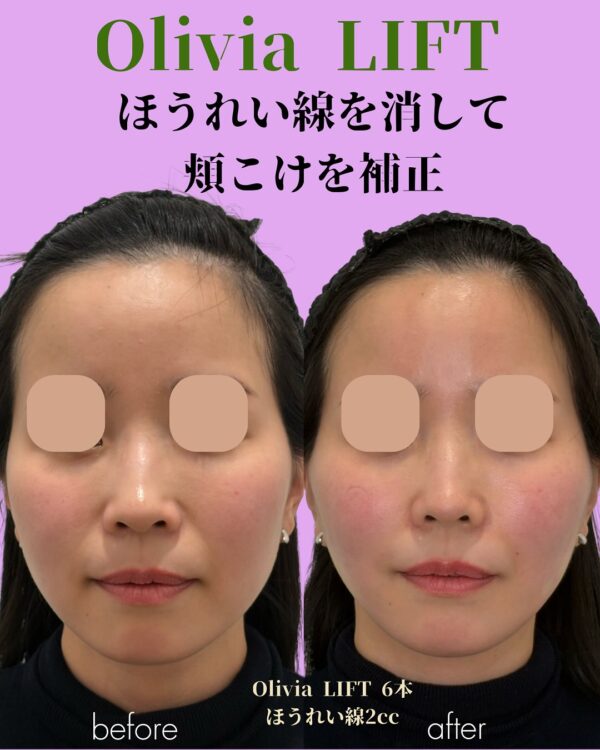 288 Olivia lift × ヒアルロン酸注入