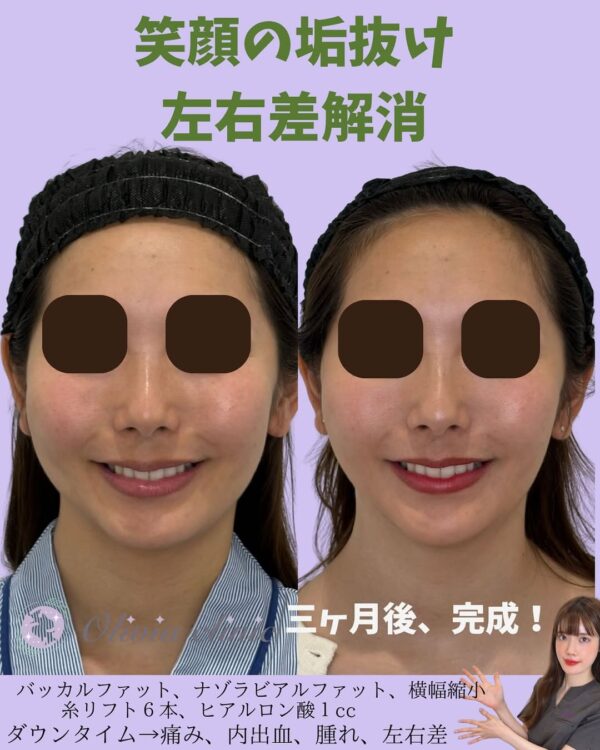 289 Olivia式小顔脂肪吸引 × ナゾラビアルファット除去 × バッカルファット除去  × 横幅縮小 × Olivia lift × ヒアルロン酸