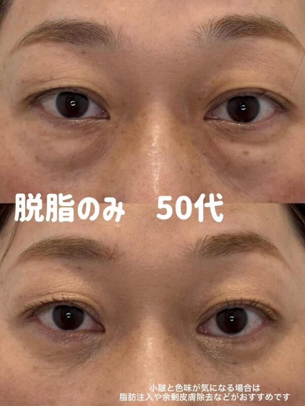 290 クマ取り（脱脂） × コンデンスリッチ脂肪注入