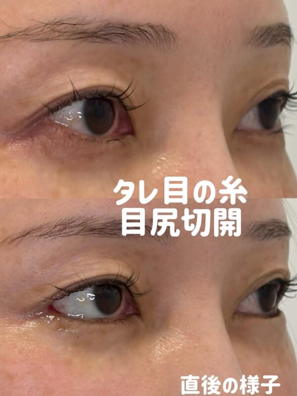 291 タレ目形成 × 目尻切開